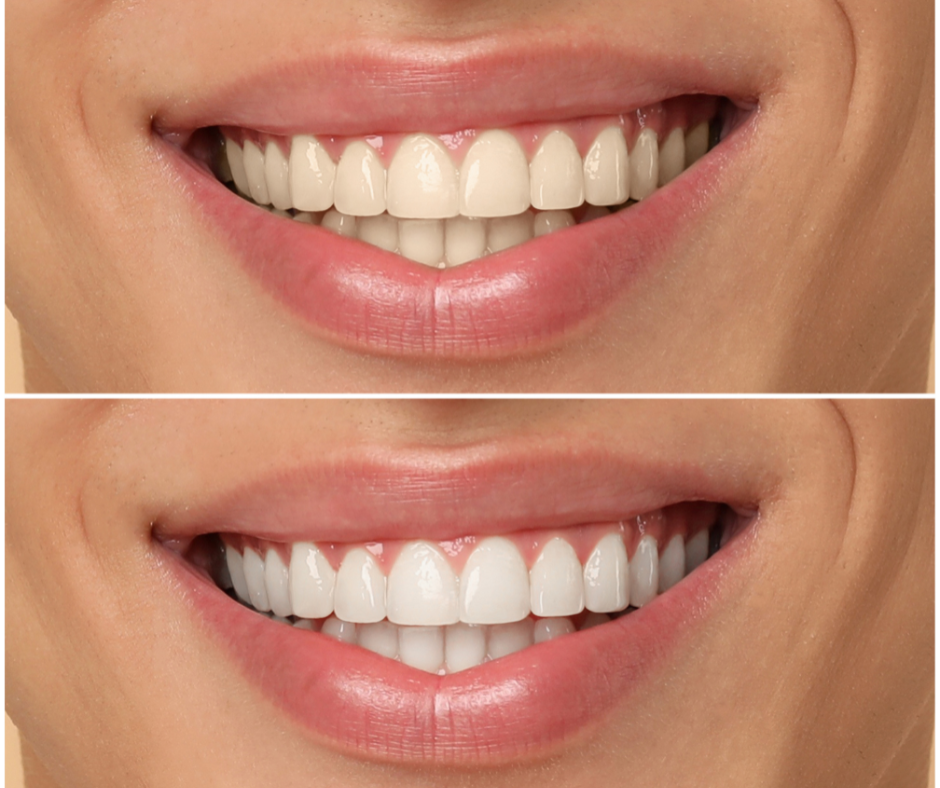 teeth whitening Cranbourne